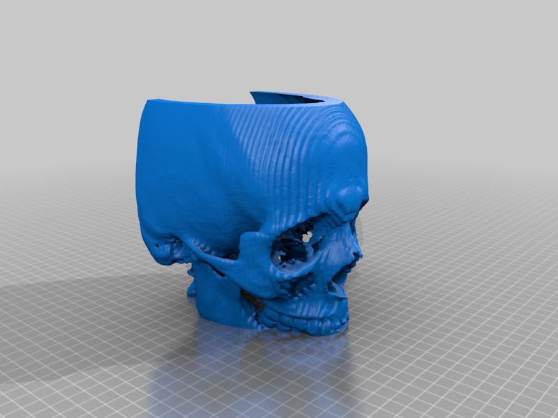 F Front Maxillo Facial Bones CT 3D Scan