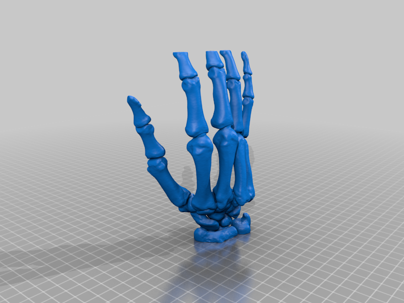 Hand bone. Dislocation 4 and 5 metacarpal joint