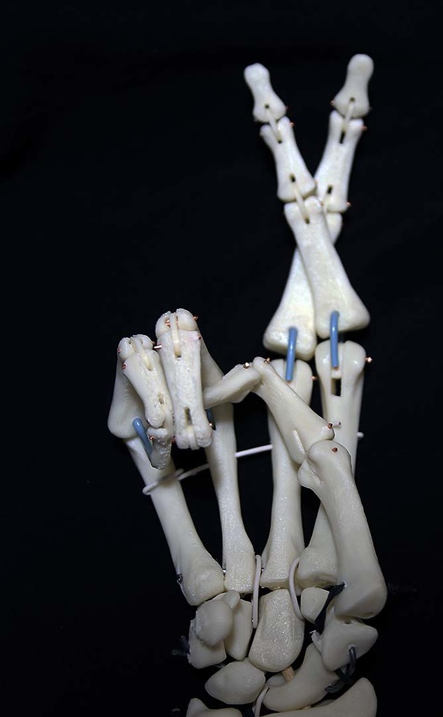 Metacarpal joint with abduction and flexion remix