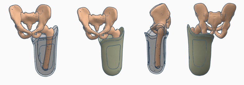 Transfemoral (above-knee) Quadrilateral Prosthetic Socket Pack 2