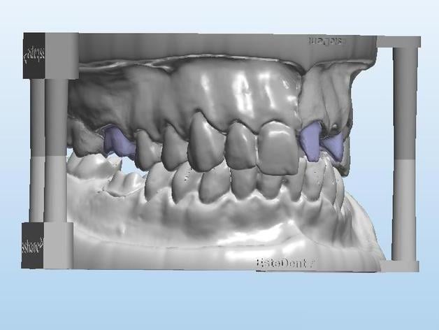 Dental Model+Antagonist+3 teeth