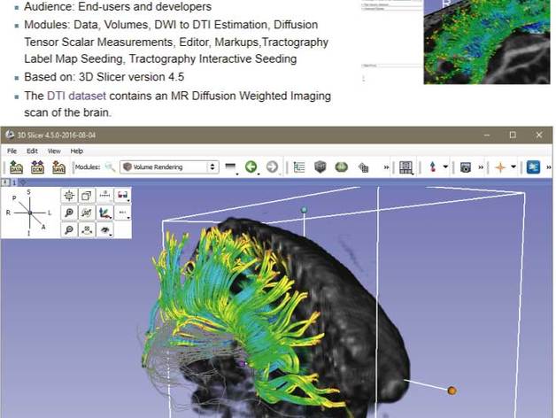 Printable Diffusion MRI analysis Brain tracts