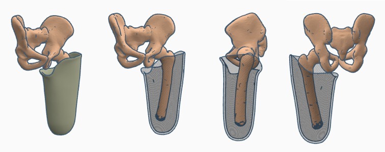 Transfemoral (above-knee) Quadrilateral Prosthetic Socket Pack 1