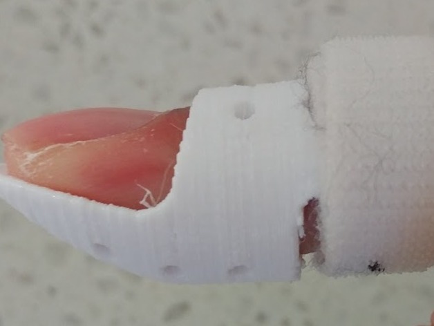 Stack Splint for Mallet Finger Injury