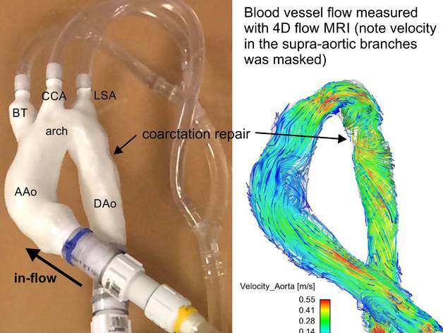 Surgically repaired coarctation of the aorta (flow model)